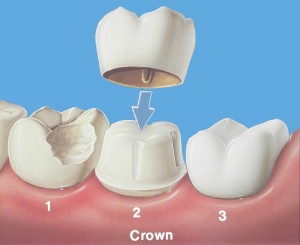 Tampa Dental Crowns | Dentisty Tampa | 813.839.2273 - Dr Marnie Bauer is a general dentist specializing in dental crowns in Tampa / South Tampa and the surrounding area. - Tampa FL Dental Crown Specialists
