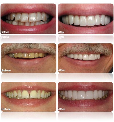 Porcelain Veneers Tampa FL | Dentist Tampa | 813.839.2273 - Tampa Porcelain Veneers Dentist Tampa FL Florida - Dr Marnie Bauer is a general dentist specializing in porcelain veneers in Tampa / South Tampa and the surrounding area. - Tampa Porcelain Veneers Specialists