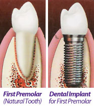 Tampa Dental Implants | Dentist South Tampa | 813.839.2273 | Dental Implants Tampa FL Florida - Dr Marnie Bauer is a general dentist specializing in dental implants in Tampa / South Tampa and the surrounding area. - Tampa Dental Implant Dentist South Tampa Florida FL - Dental Implants Tampa