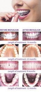 Invisalign Tampa Florida FL - Dr Marnie Bauer is a general dentist specializing in Invisalign / orthodontics in Tampa / South Tampa and the surrounding area. - Tampa FL Invisalign Specialists