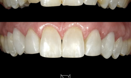 Cosmetic Dentistry – Before and Afters